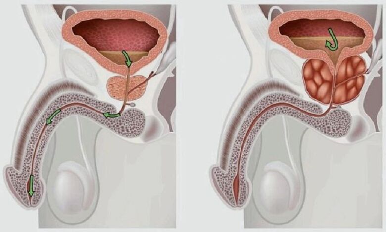 Behinderung des Abflusses von Urin prostatitis