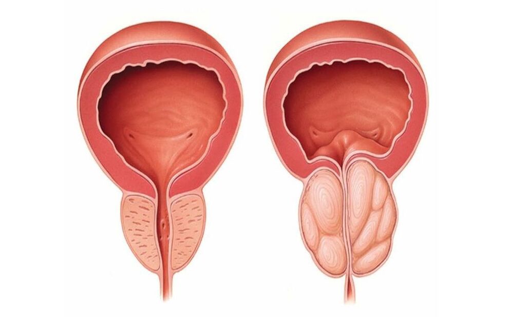 normale und entzündete Prostata