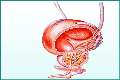 Eine Entzündung der Prostata bei akuter Prostatitis stellt eine Einschränkung beim Sex dar