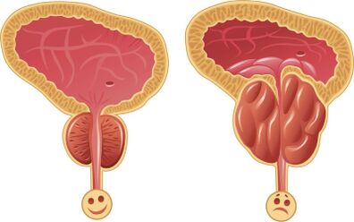 Gesunde und entzündete männliche Prostata