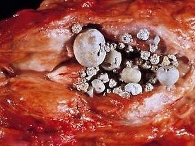 Steine ​​in der Prostata bei kalkhaltiger Prostatitis